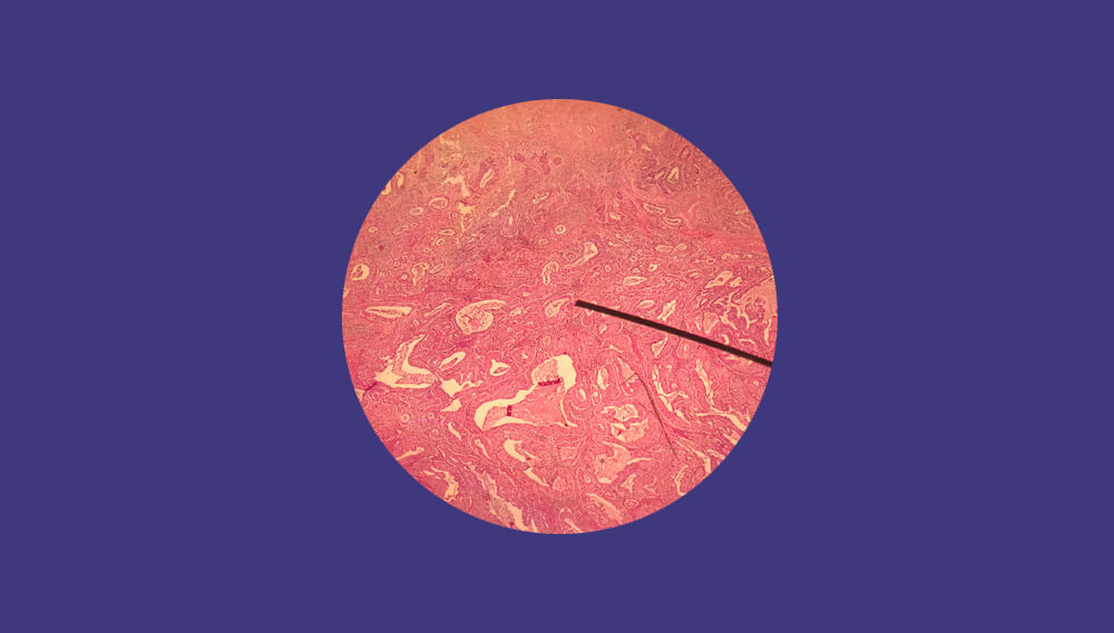 HPV under a microscope.