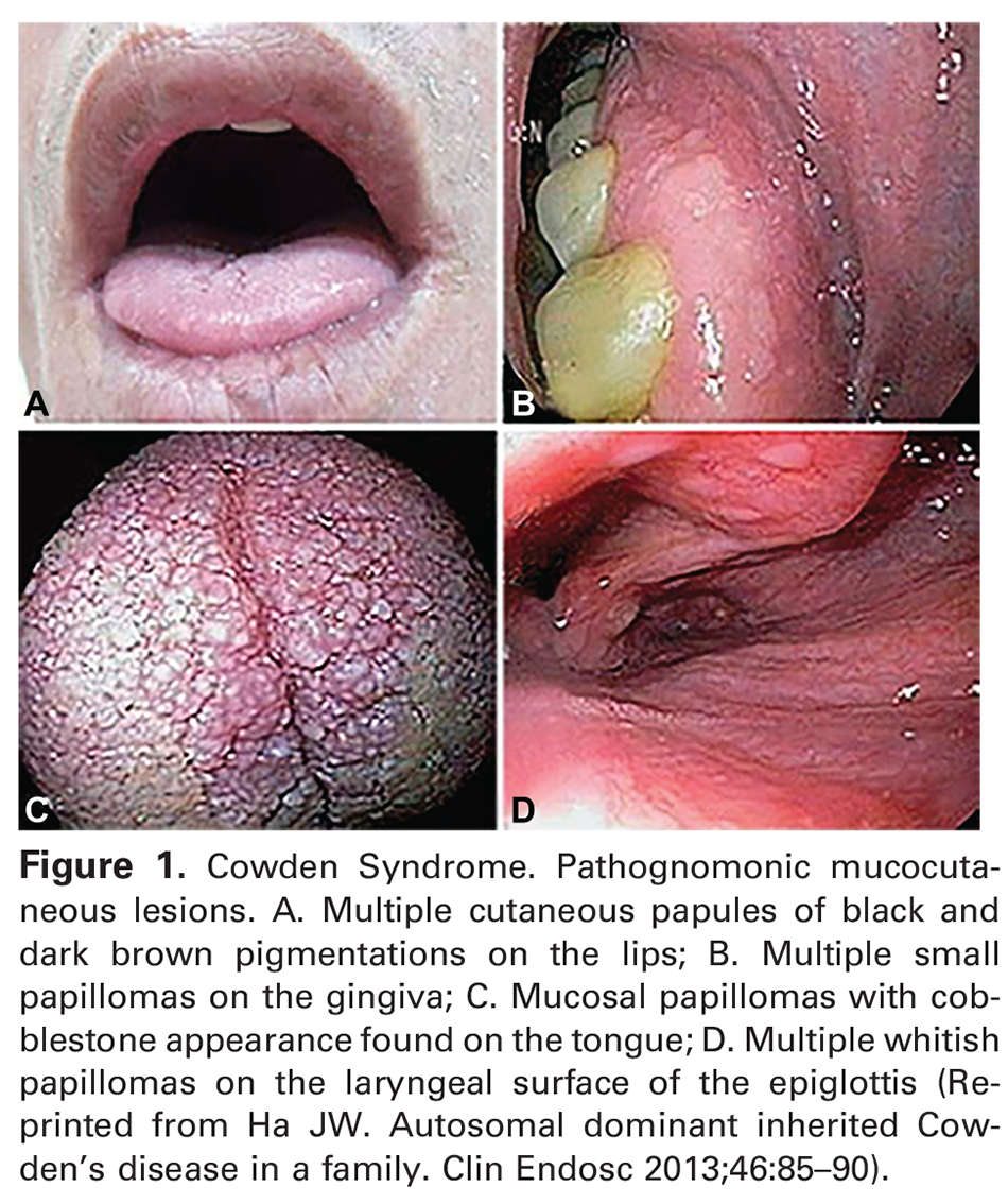 Figure 1. Cowden Syndrome. Pathognomonic mucocutaneous lesions. A. Multiple cutaneous papules of black and dark brown pigmentations on the lips; B. Multiple small papillomas on the gingiva; C. Mucosal papillomas with cobblestone appearance found on the tongue; D. Multiple whitish papillomas on the laryngeal surface of the epiglottis (Reprinted from Ha JW. Autosomal dominant inherited Cowden’s disease in a family. Clin Endosc 2013;46:85–90). 