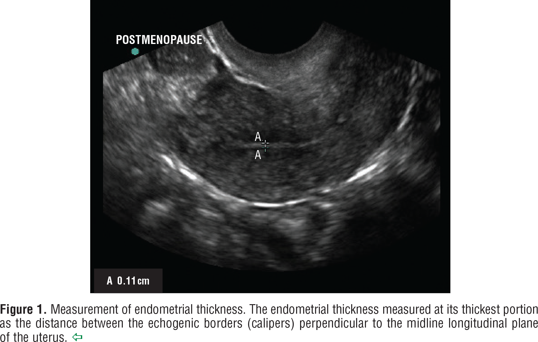 The Role of Transvaginal Ultrasonography in Evaluating the Endometrium of Women With Postmenopausal Bleeding