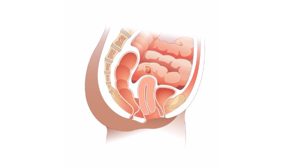 An internal view of pelvic organ prolapse. The uterus has dropped down into the vagina. 